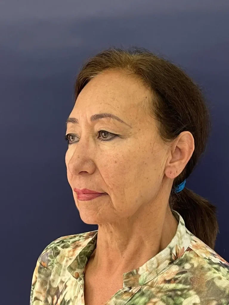 Blefaroplastia Caso 2 Antes