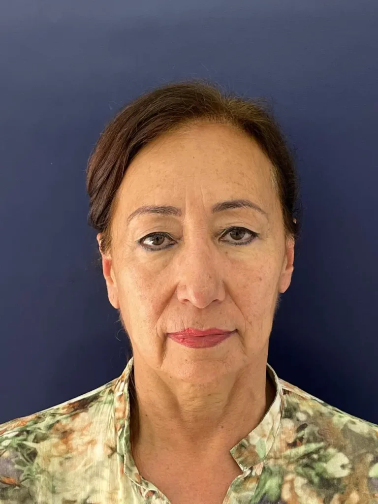 Blefaroplastia Caso 2 Antes(1)