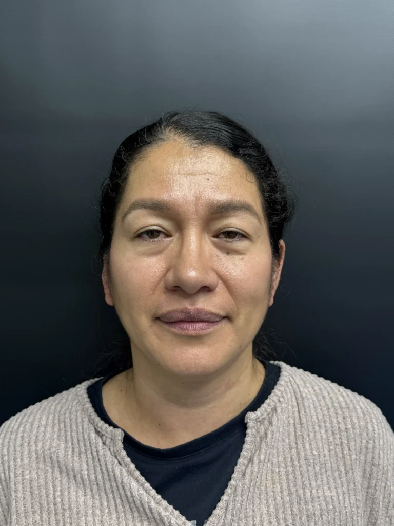 Blefaroplastia Caso 3 Antes 1