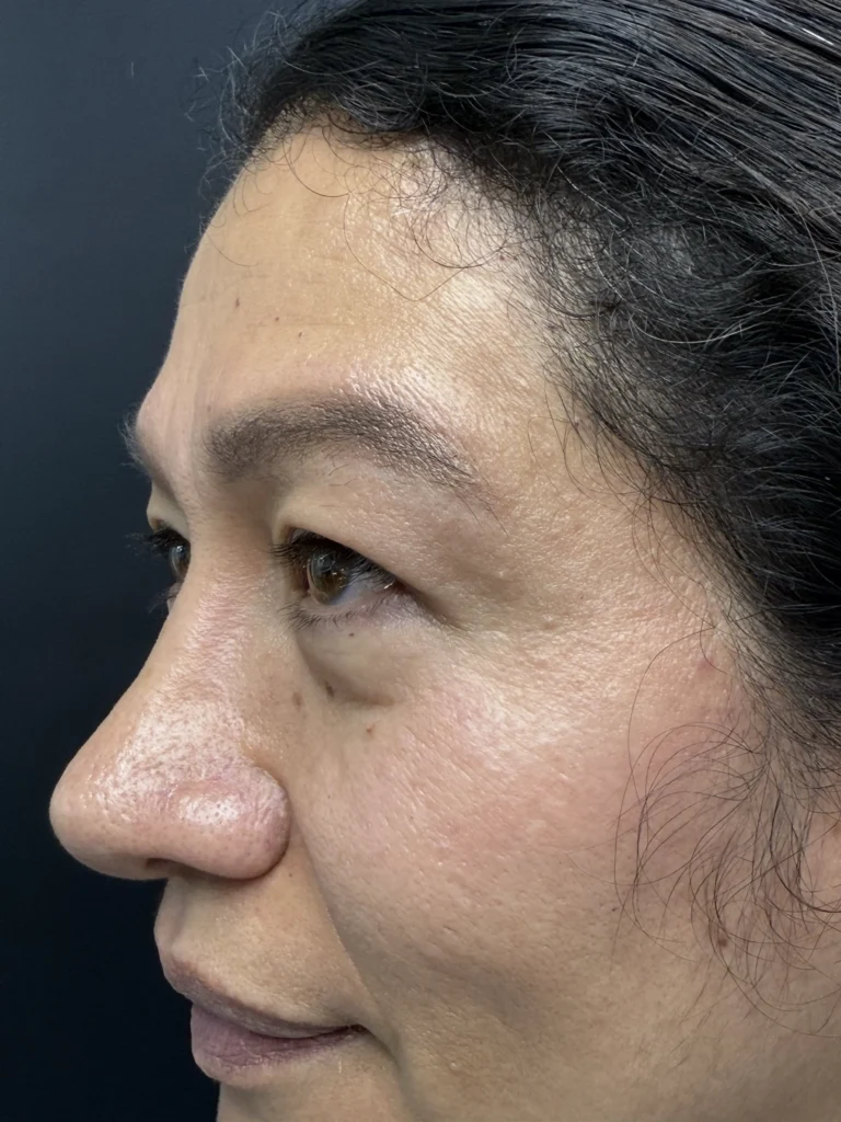 Blefaroplastia Caso 3 Antes 2