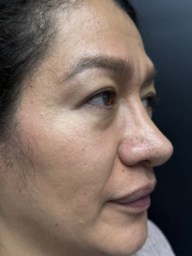 Blefaroplastia Caso 3 Antes 3