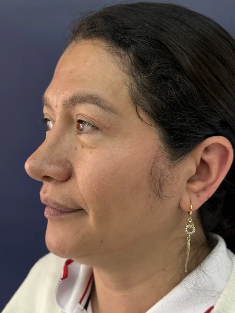 Blefaroplastia Caso 3 Resultado 2