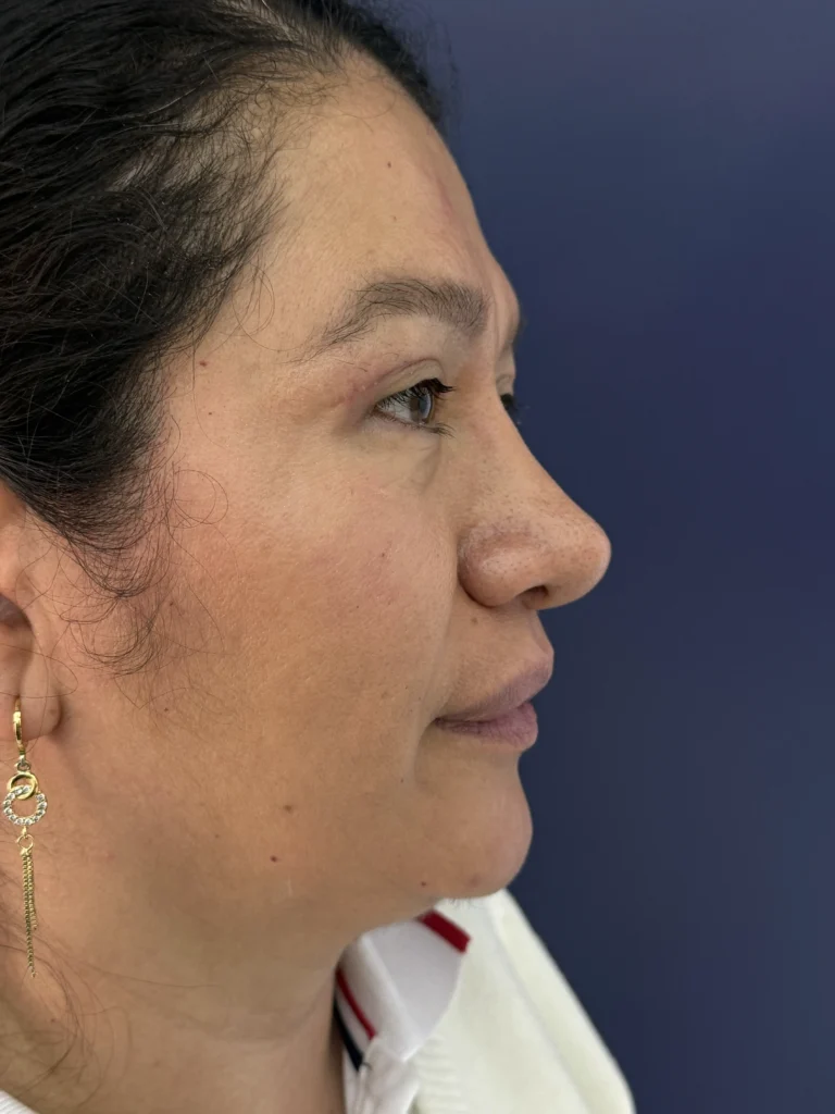 Blefaroplastia Caso 3 Resultado 3