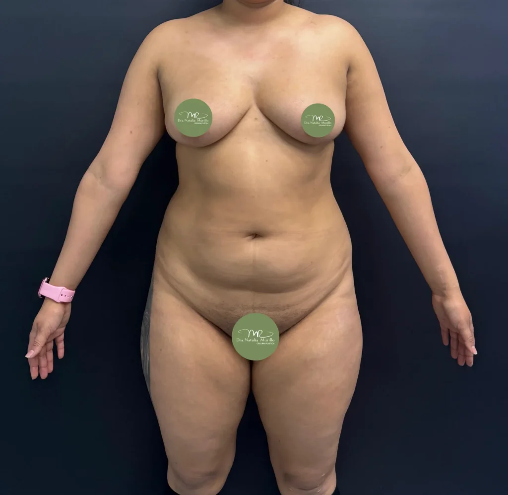 Liposuccion 360 Antes 1