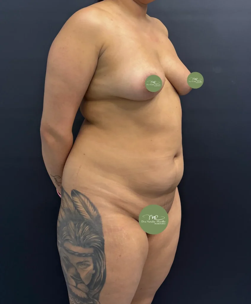 Liposuccion 360 Antes 2