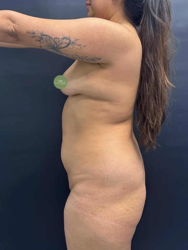 Liposuccion 360 Antes 4