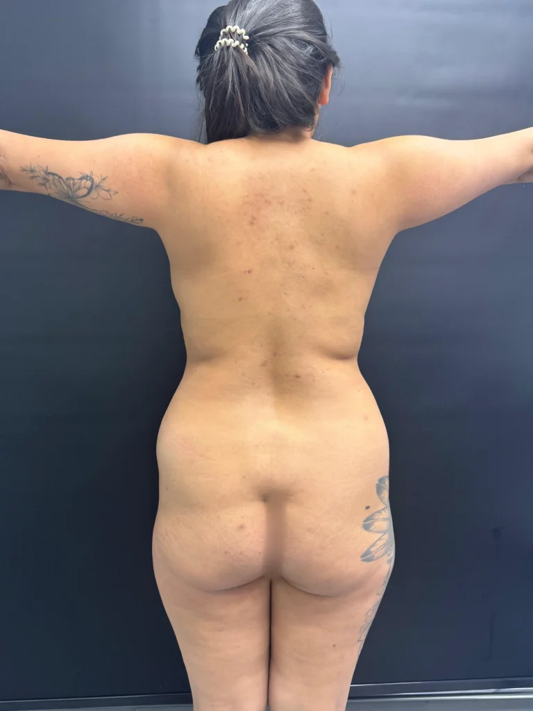 Liposuccion 360 Antes 6