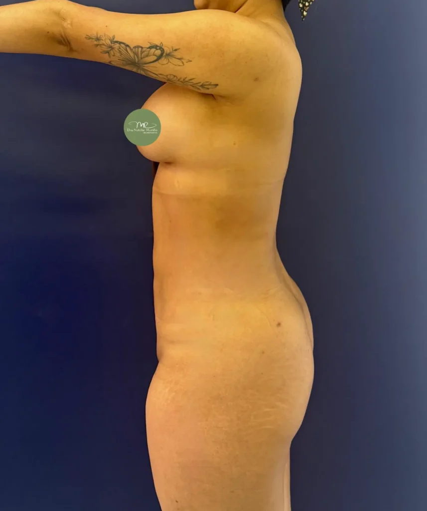 Liposuccion 360 Resultado 4