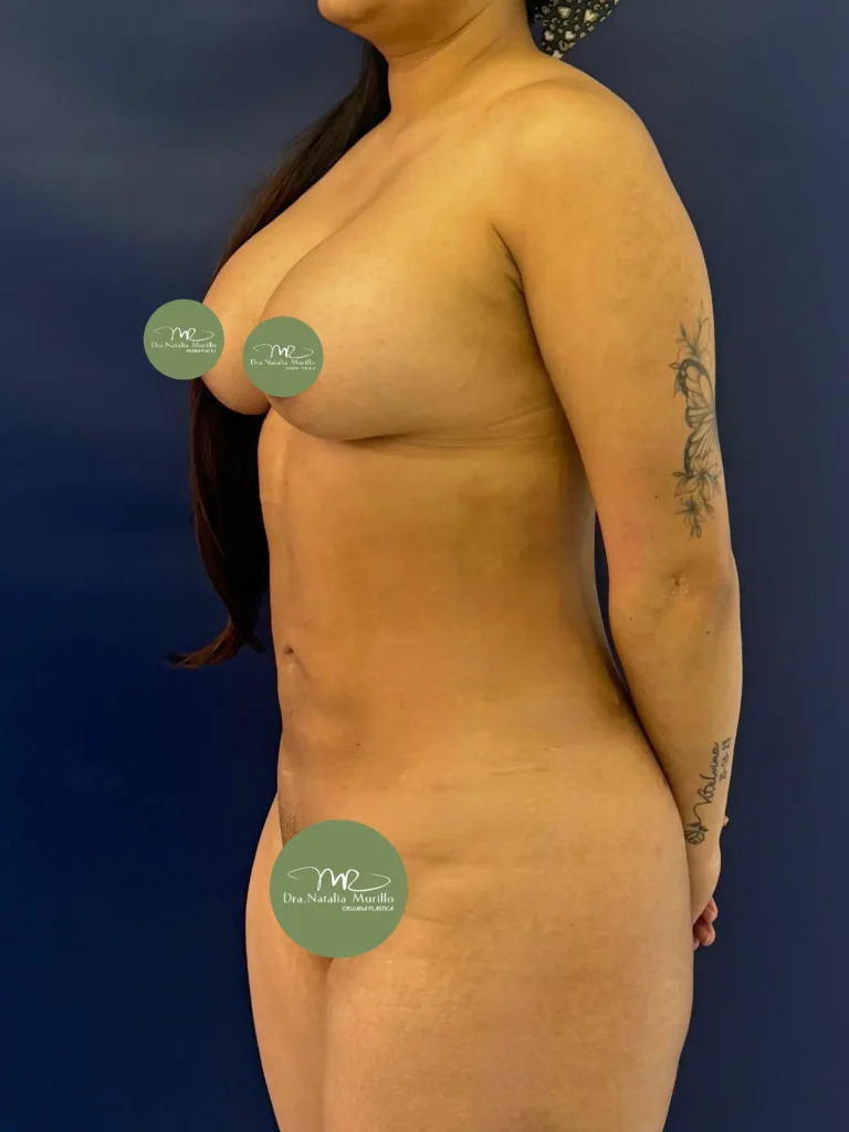 Liposuccion 360 Resultado 5