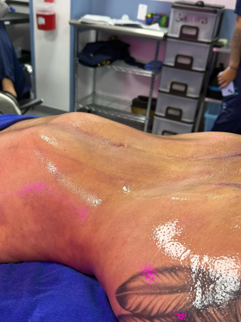 Liposuccion 360 Resultado inmediatos 1