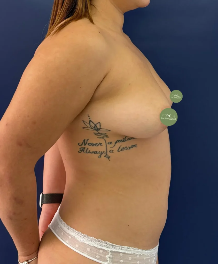 Pexia con implantes (T invertida) Antes 2