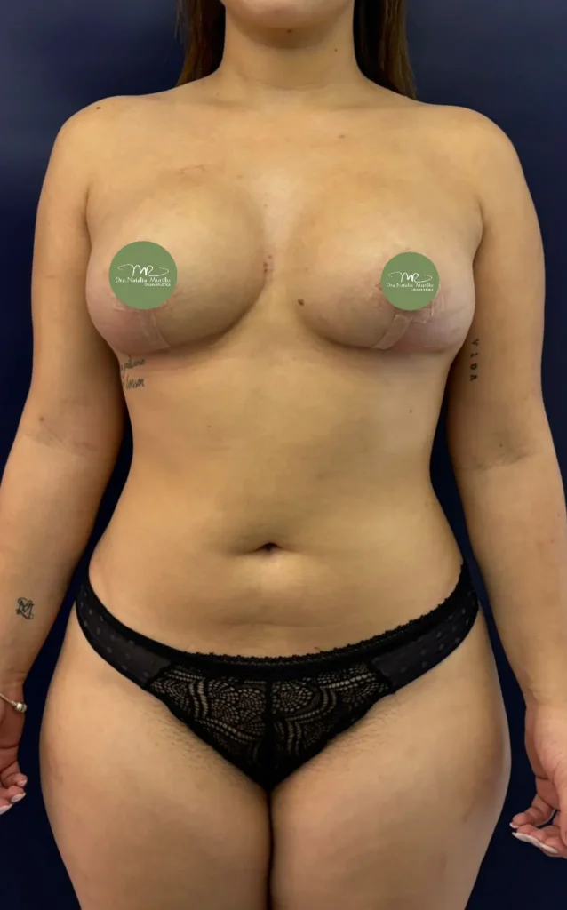 Pexia con implantes (T invertida Resultado 1