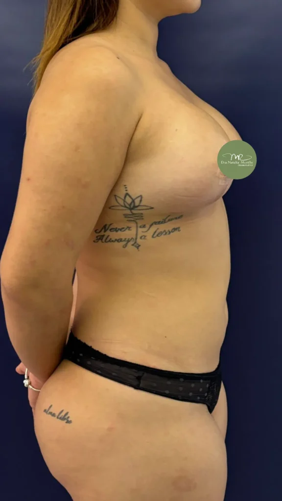 Pexia con implantes (T invertida) Resultado 3