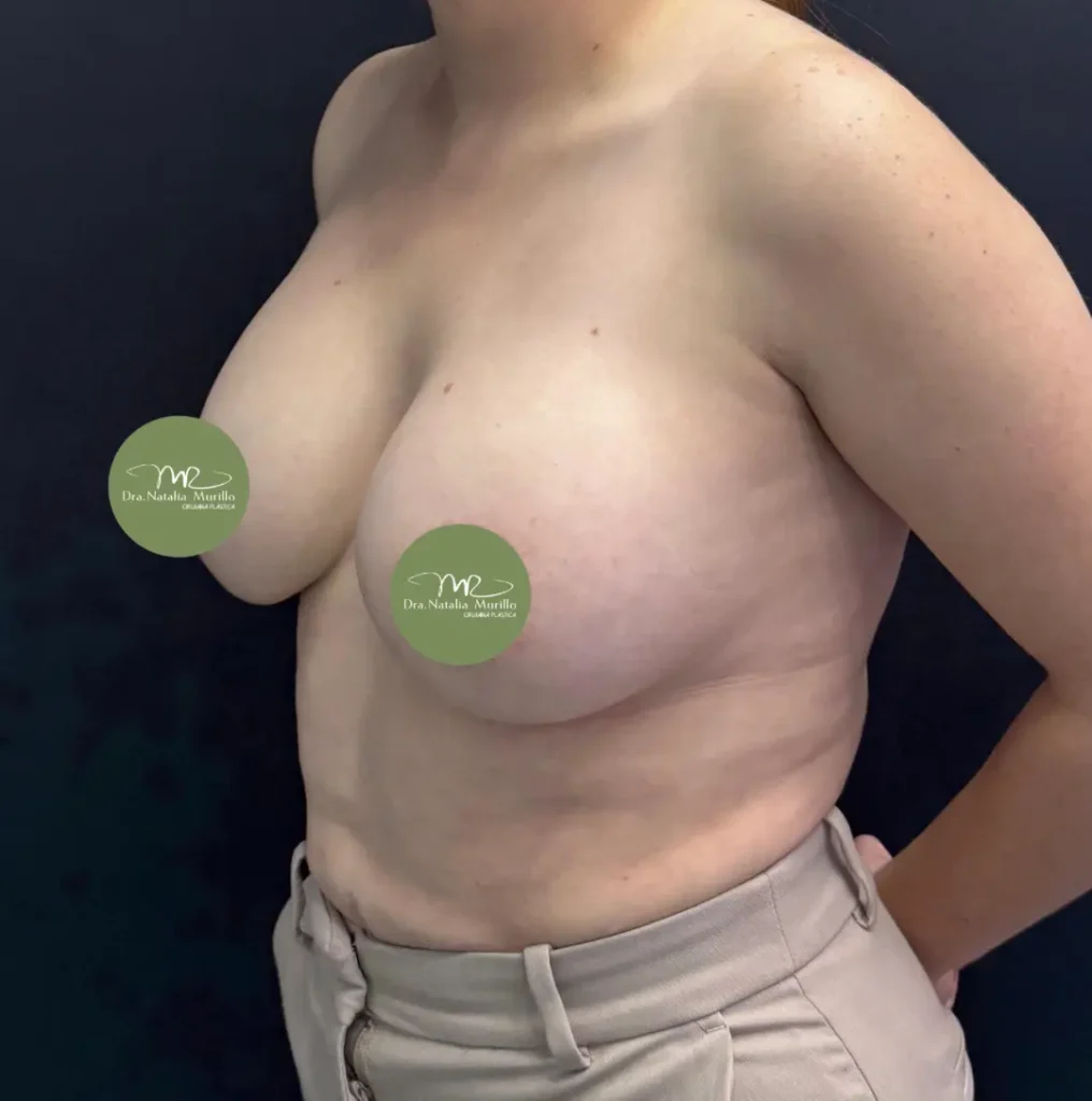 Pexia mamaria Antes 1