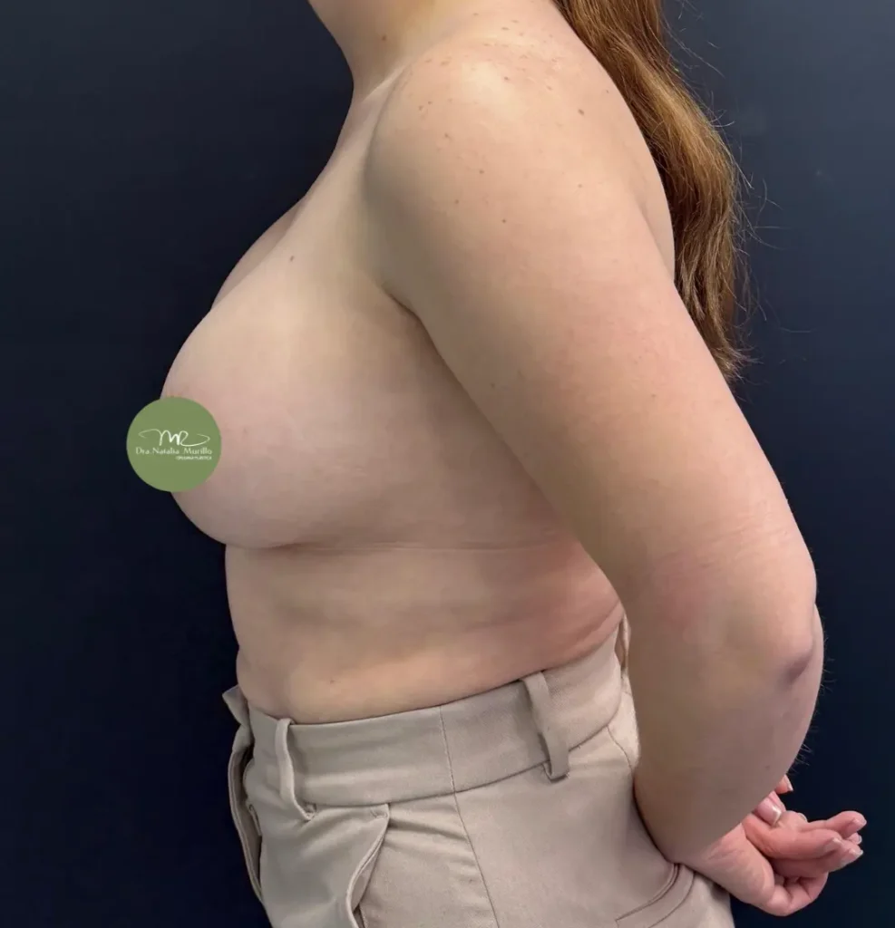 Pexia mamaria Antes 2