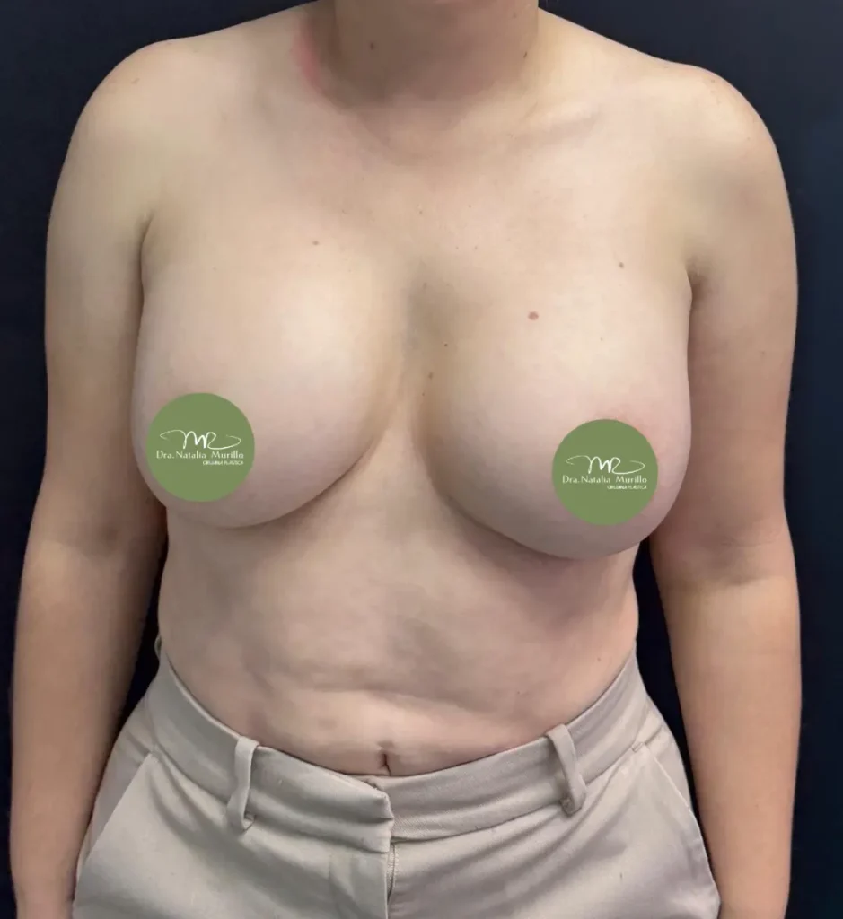 Pexia mamaria Antes 3