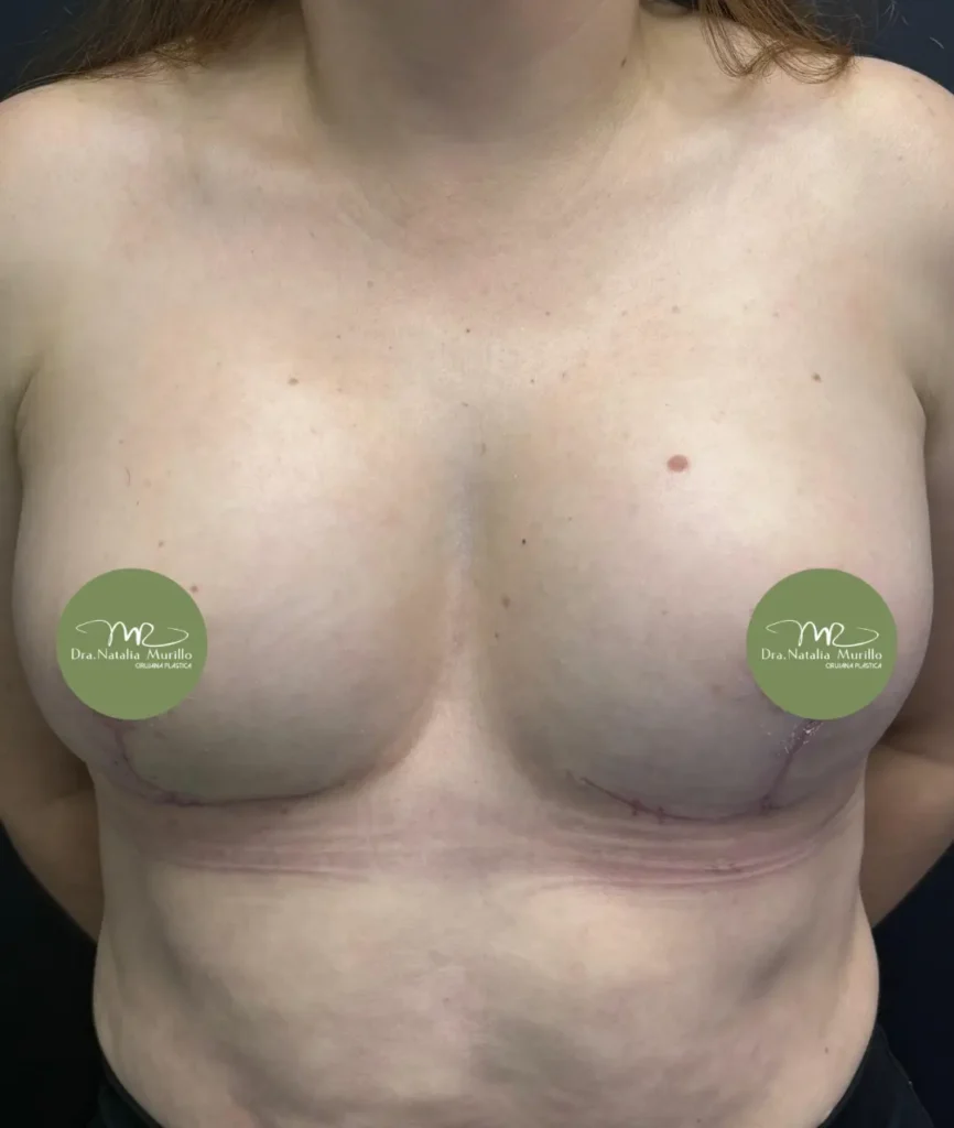 Pexia mamaria Resultado 4