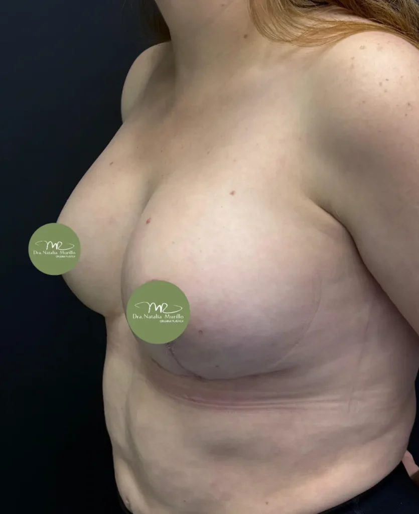 Pexia mamaria Resultado 6