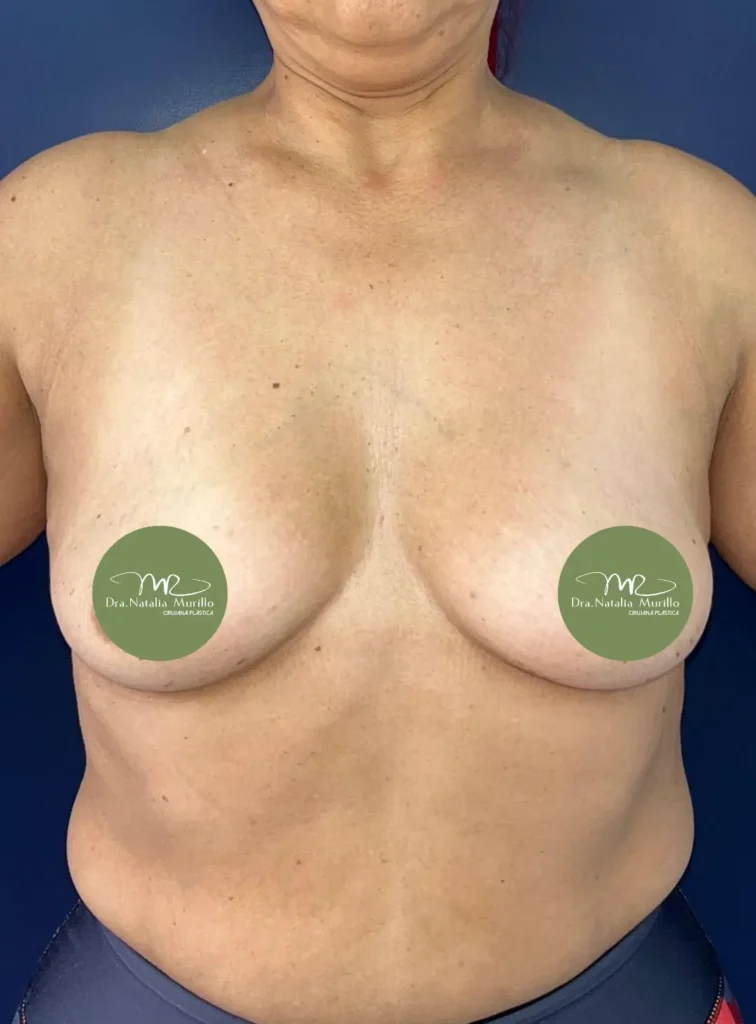 Pexia periareolar con implantes Antes