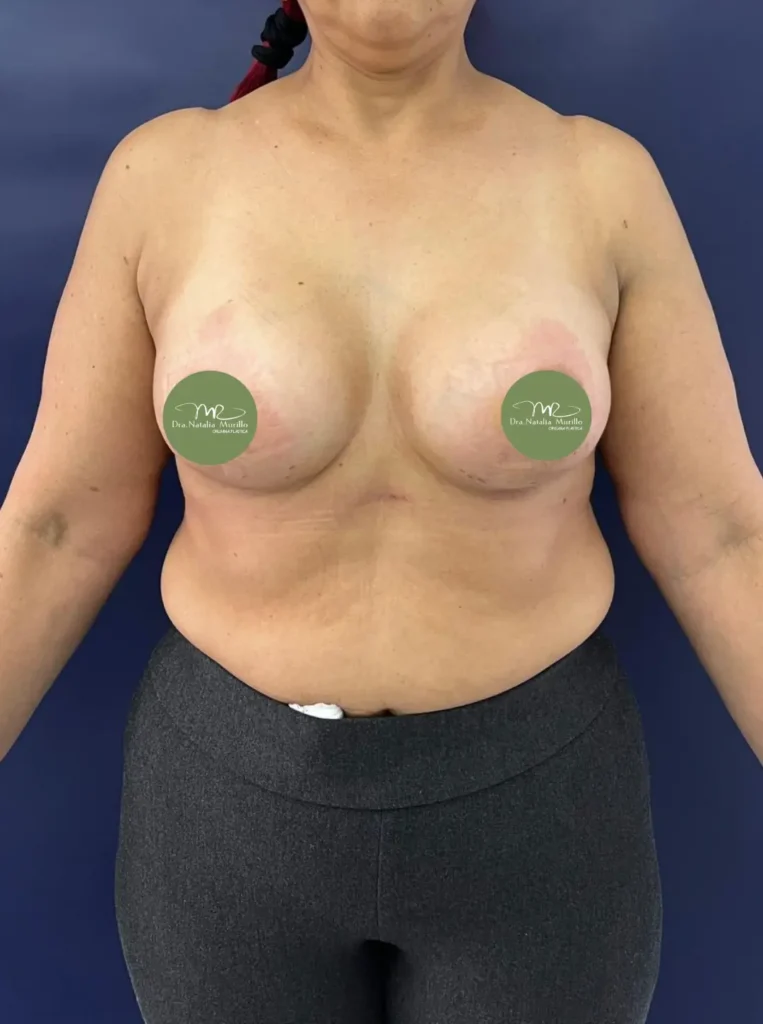 Pexia periareolar con implantes Resultado 1