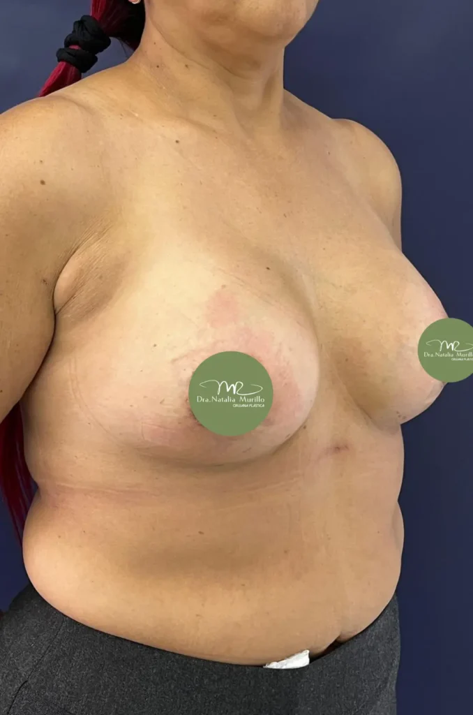 Pexia periareolar con implantes Resultado 2