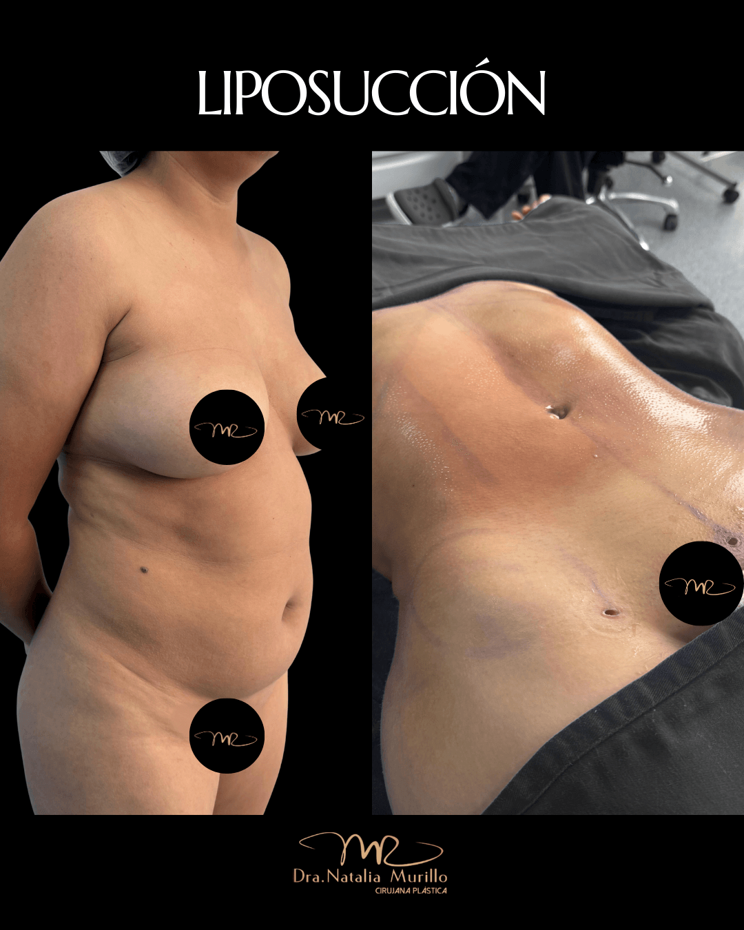 Lipo Perfil Bogota acostada