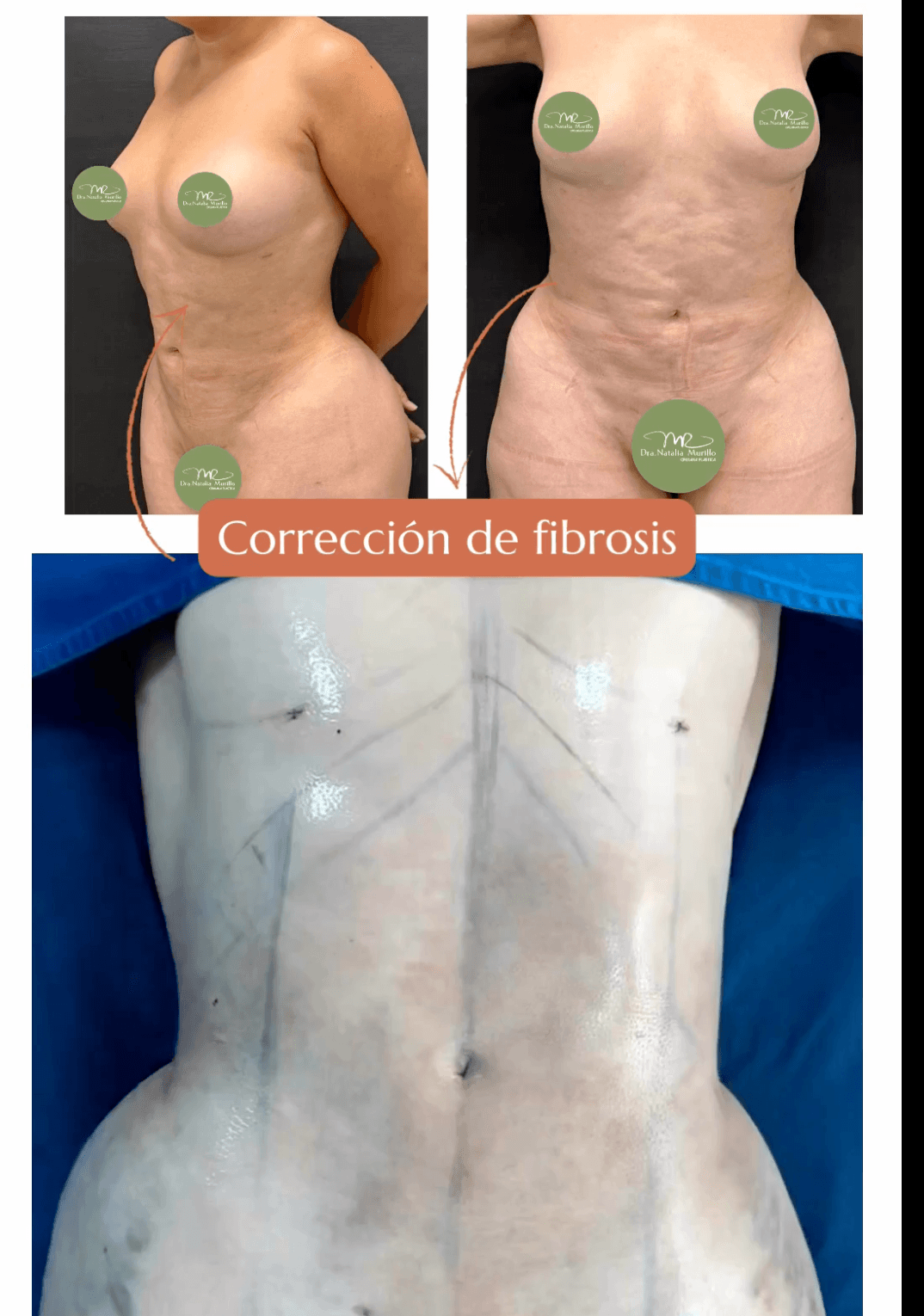 Antes-Despues-Correccion-Fibrosis