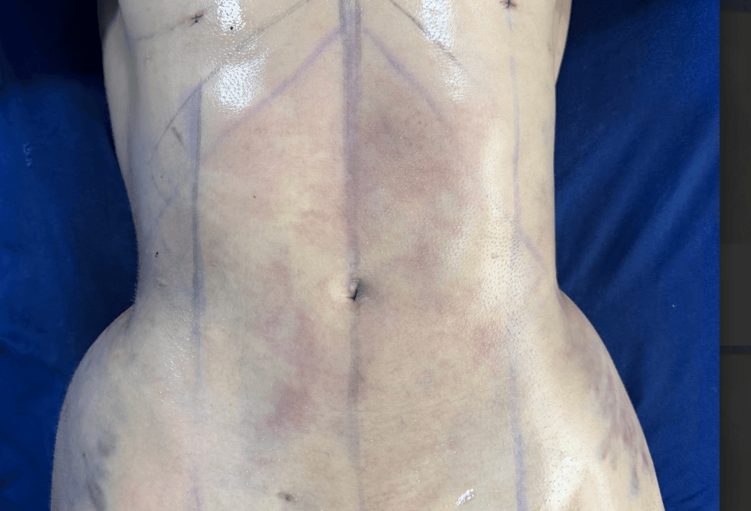 Correccion-Fibrosis-Intraoperatoria