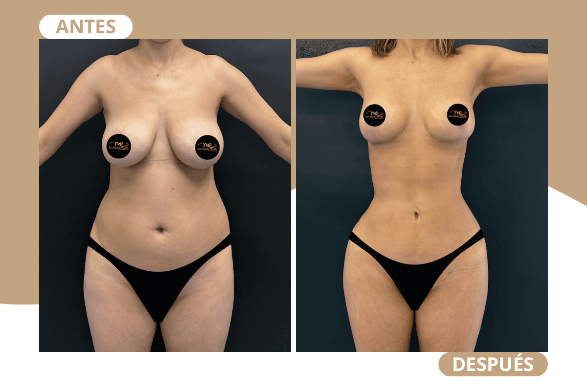 liposuccion-360-caso-01