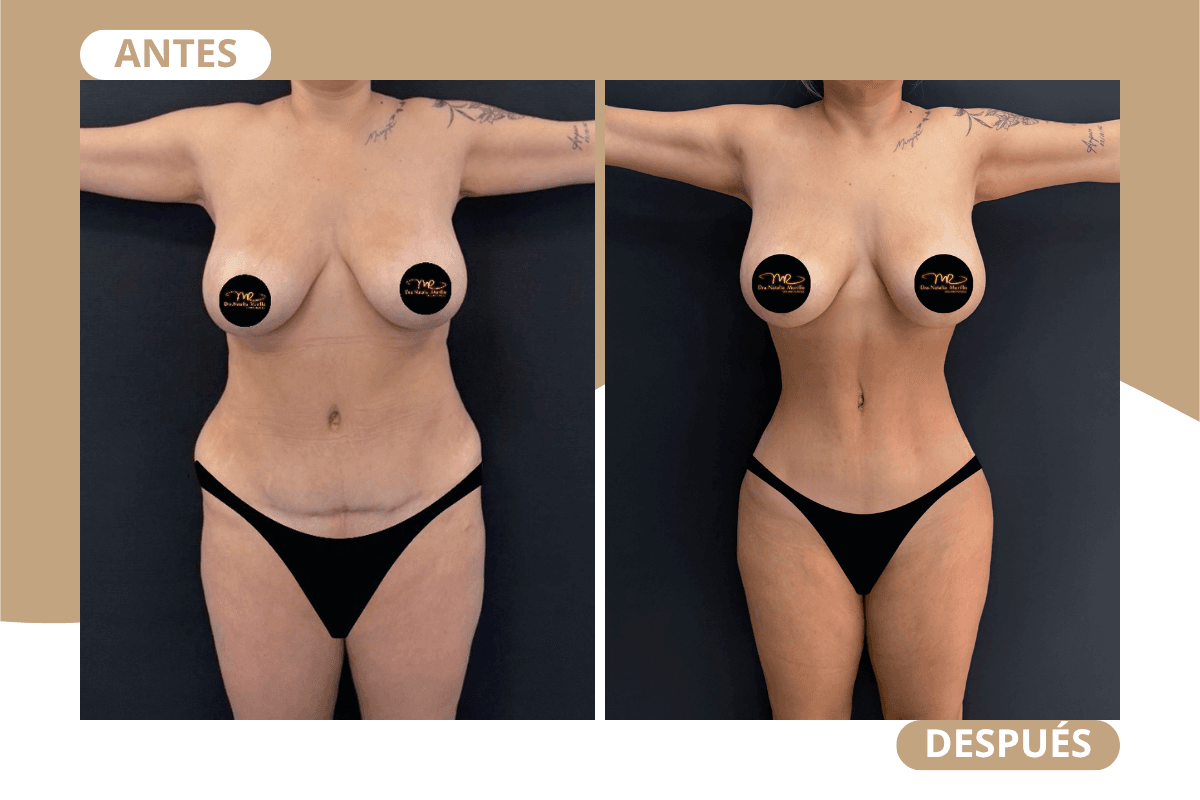 liposuccion-360-caso-02