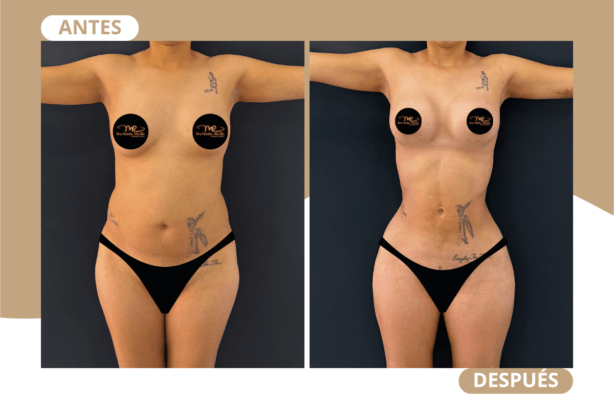 liposuccion-360-caso-03