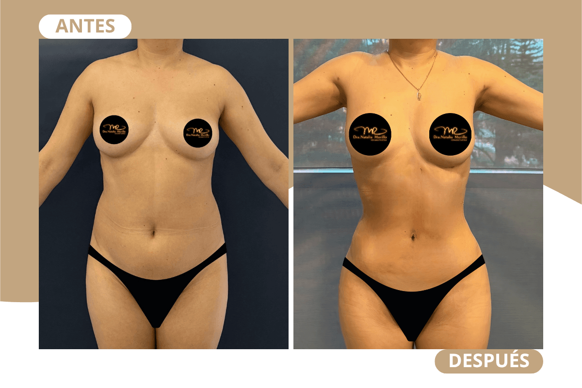 liposuccion-360-caso-04