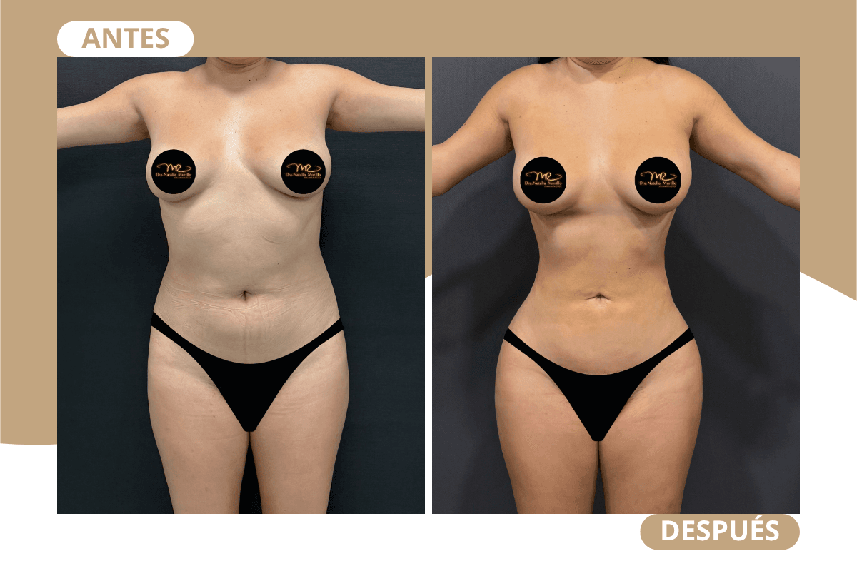 liposuccion-360-caso-05
