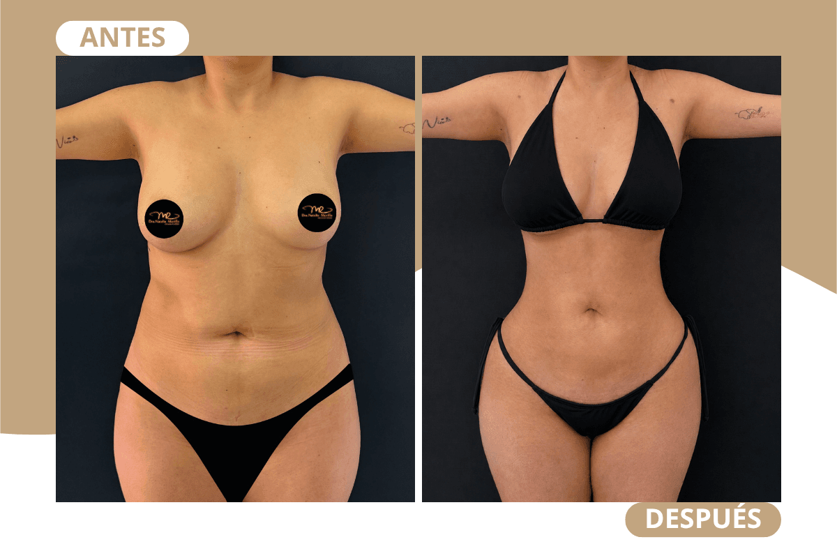 liposuccion-360-caso-06