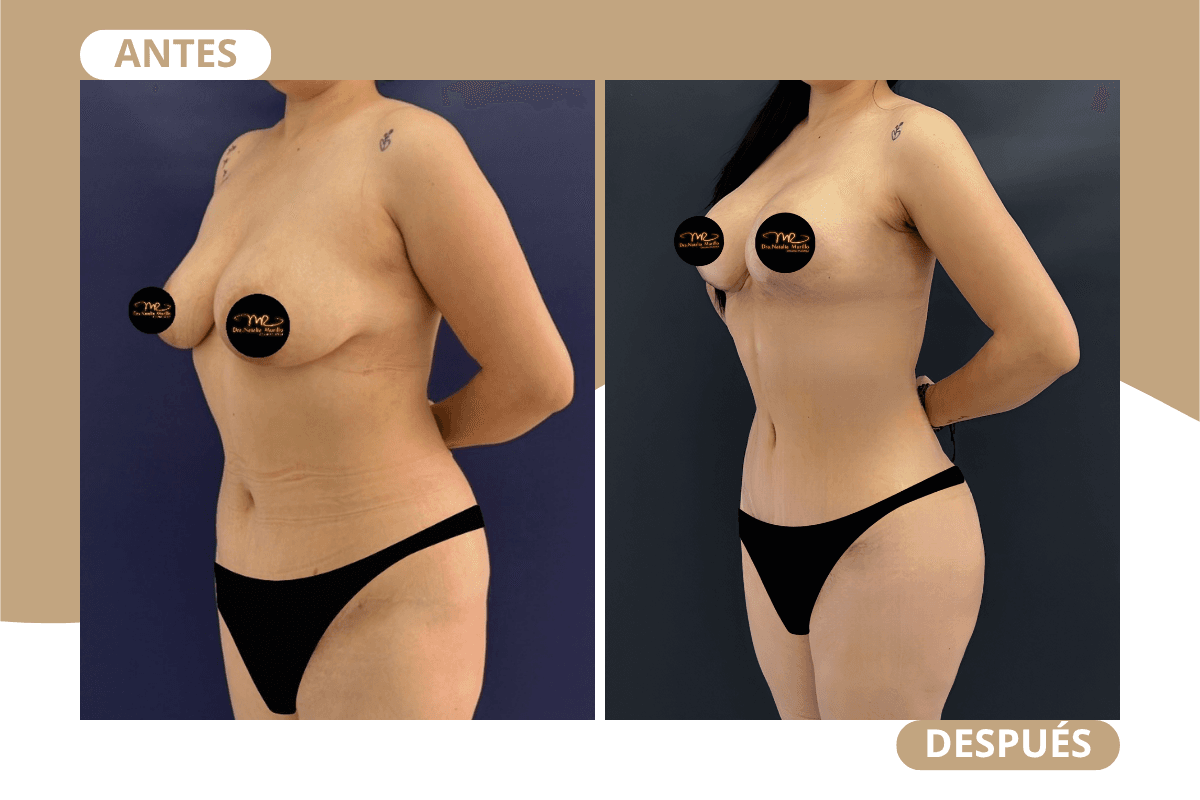 mommy-makeover-caso-01
