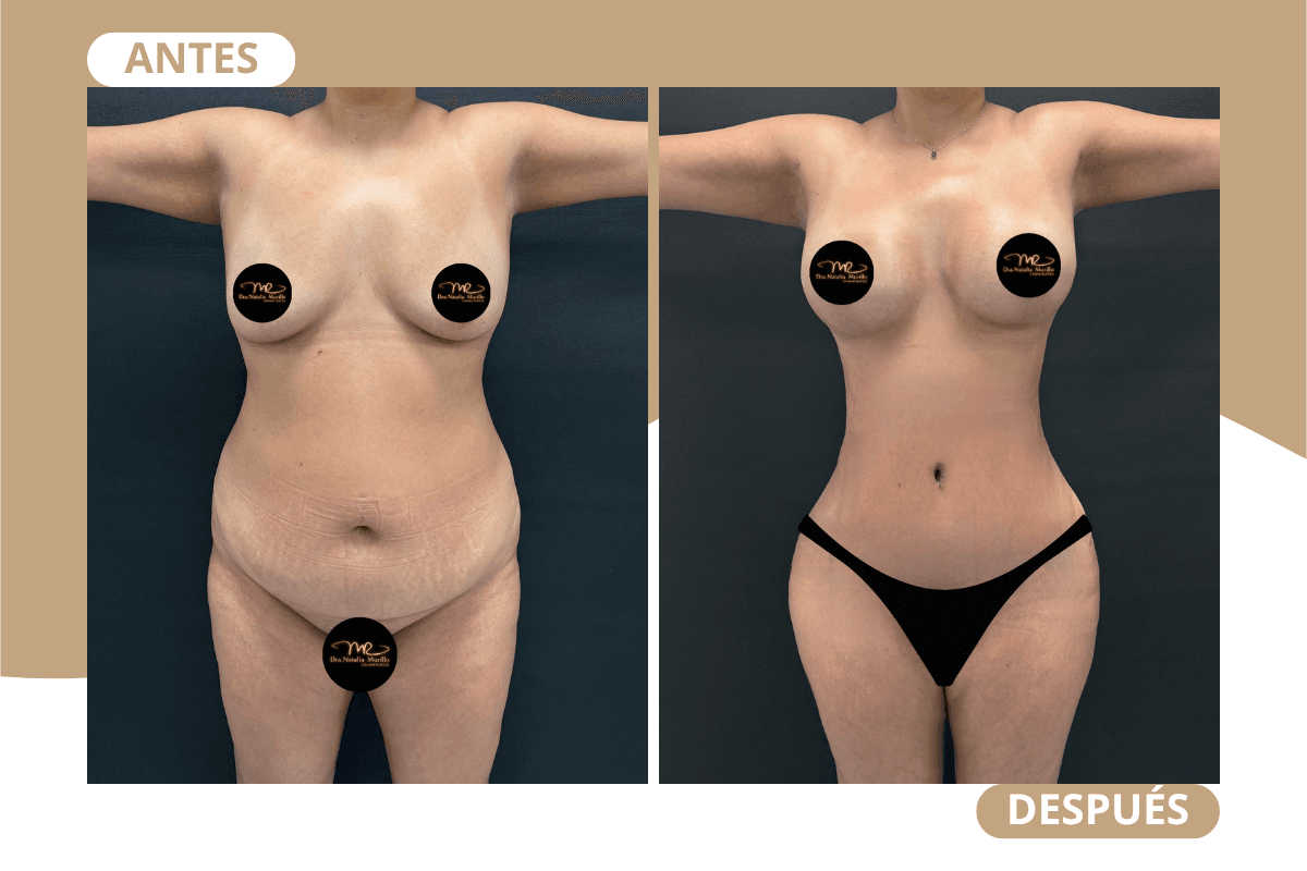 mommy-makeover-caso-02