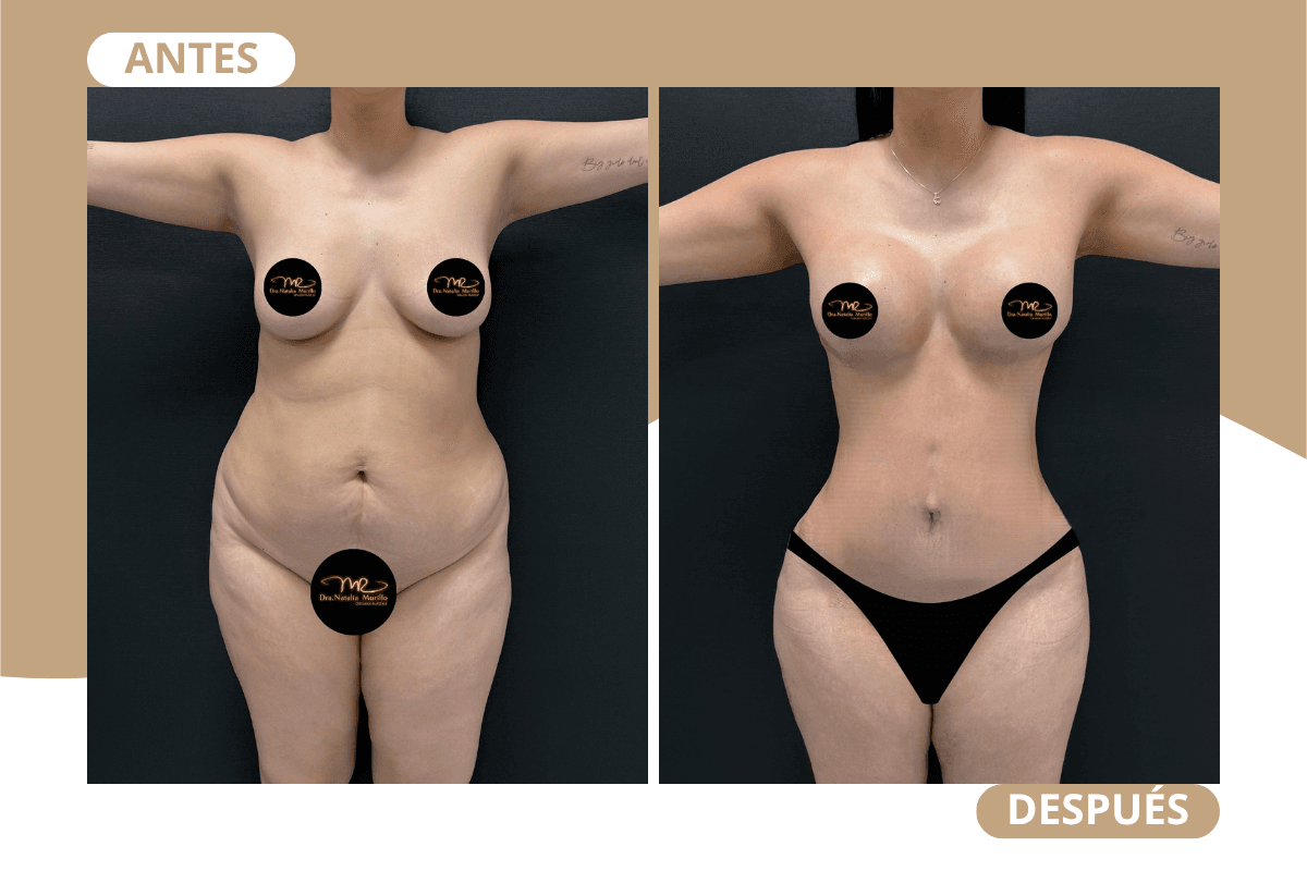 mommy-makeover-caso-03