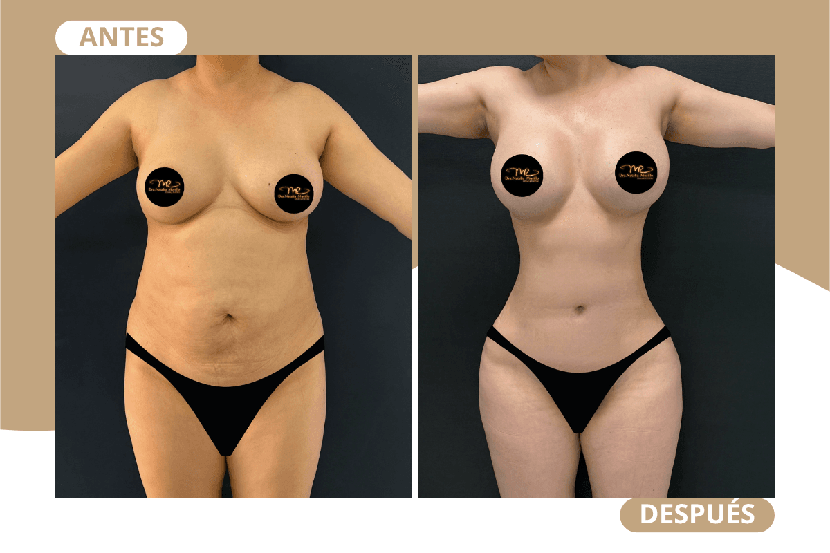 mommy-makeover-caso-04
