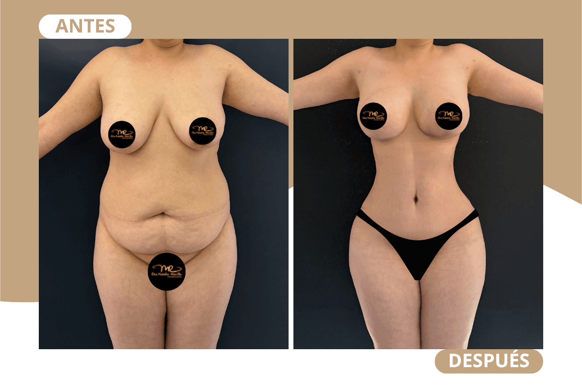 mommy-makeover-caso-05