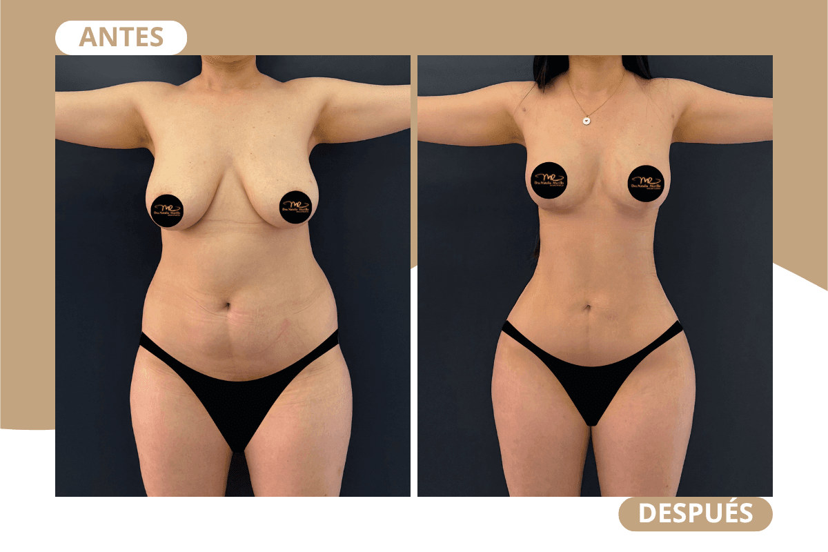 mommy-makeover-caso-06